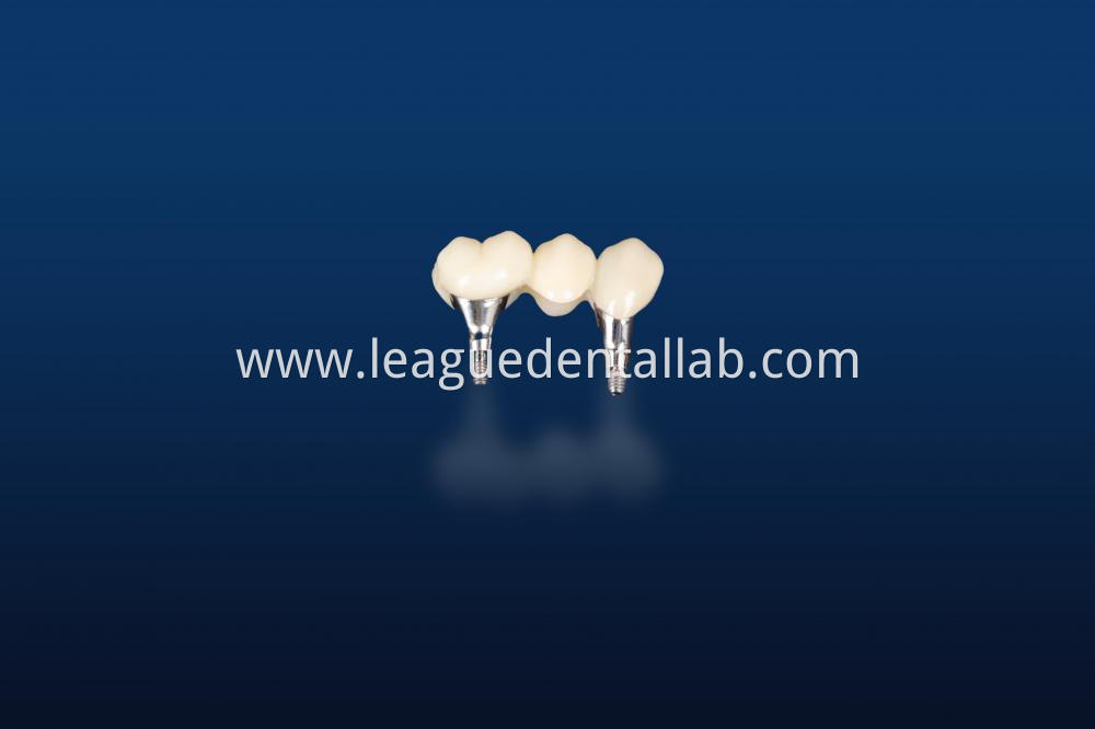 Dental Implant Crown, Dental Implant Zirconia crown,Dental Implant Emax crown,Dental Implant Bridge